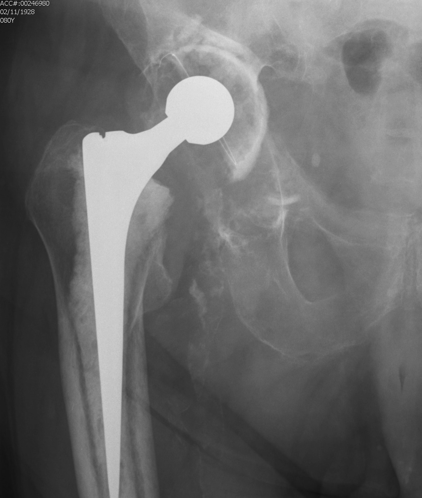 Revision THR Type 3B Acetabulum